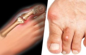 Reducerea nivelului de acid uric posibilă cu 4 alimente