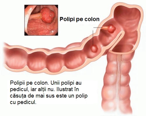 Polipii pe colon pot fi cu pedicul sau fără