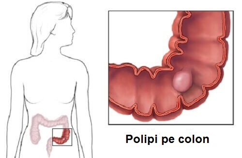 Polipii pe colon – câteva informații utile