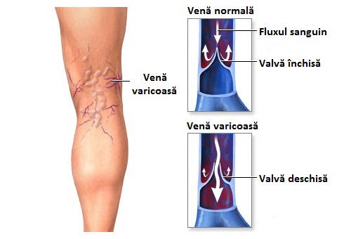 Poți preveni varicele cu dușuri reci
