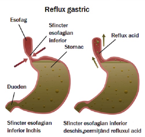 Refluxul gastric reprezentat grafic