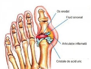 Scăpați de cristalele de acid uric din articulații