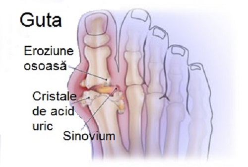 Cum să scăpați de cristalele de acid uric care provoacă gută