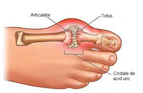 Scăpați de cristalele de acid uric din articulațiile degetelor de la picior