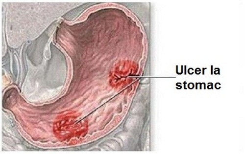 Simptome date de ulcerul gastric