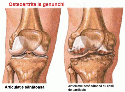 Artrită în genunchi tratamentul natural