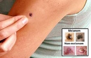Cauzele și simptomele cancerului de piele