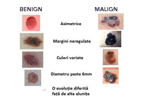 Simptomele cancerului de piele prezente la alunițe
