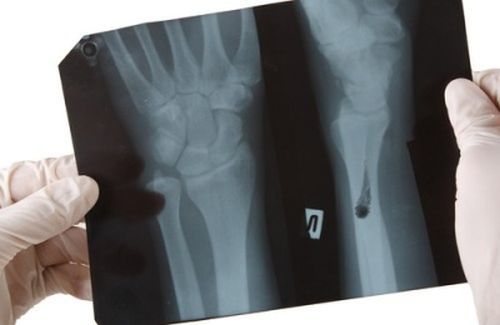 Alimente care afectează sistemul osos