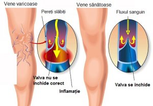 Simulatoare de picior i varicoza, Consecință după operația varicelor