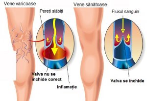 Exerciții pentru vene varicoase