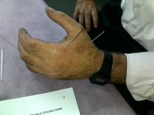 Acupunctura, punctul ling gu stimulat