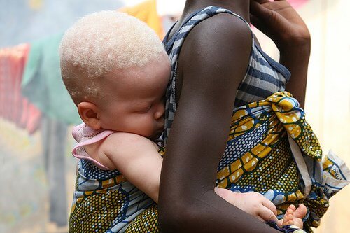 Albinismul la un copil bolnav