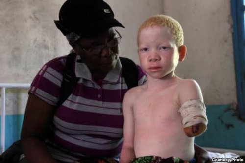 Albinismul la un copil copil mutilat