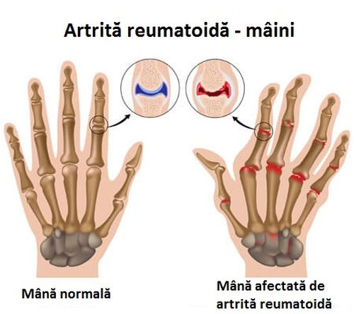 Apa de vinete previne artrita reumatoidă a mâinilor