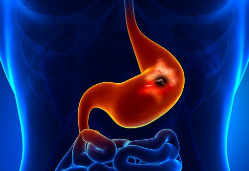 Arsura pe lista de simptome ale ulcerului gastroduodenal