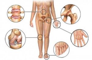 8 remedii pentru durerile articulare