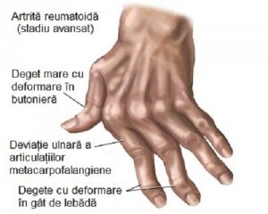 artrita reumatoidă a mâinilor