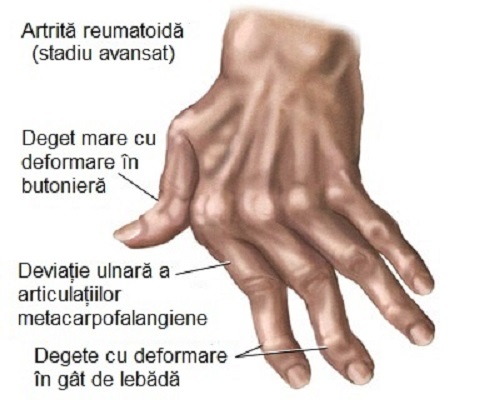 tratamentul bolii artritei)