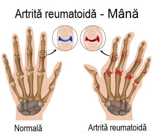 Artrita reumatoidă