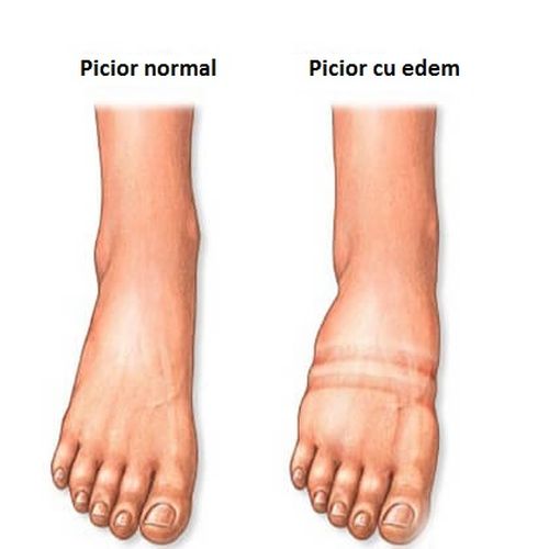 Picior care a dezvoltat edem