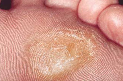 Bătăturile de la picioare: 7 remedii Bătăturile de la picioare: 7 remedii