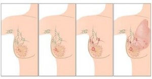 Cancerul de sân – factori de risc