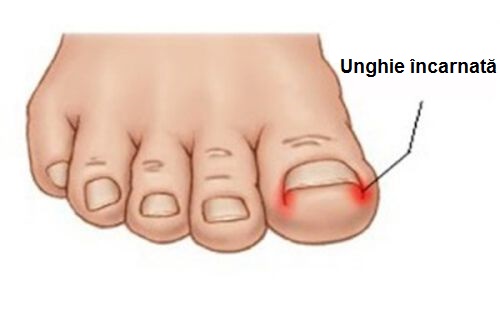 patogen al ciupercii unghiilor de la picioare lupta împotriva ciupercii picioarelor și unghiilor