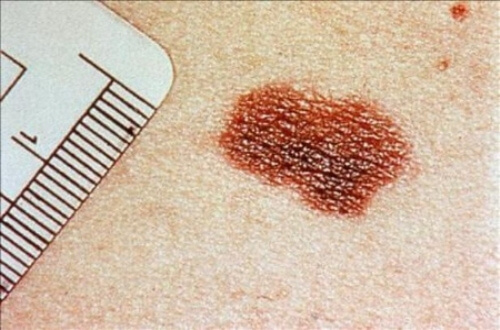Cum să depistați cancerul de piele și câte tipuri există