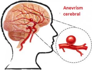 Detectarea anevrismelor și prevenirea lor