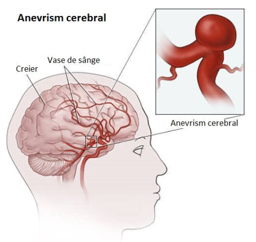 Detectarea anevrismelor cerebrale