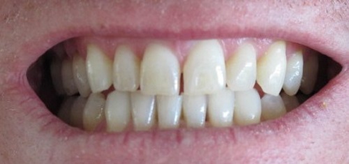Dinți albi