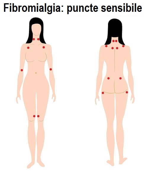 Fibromialgia: puncte sensibile