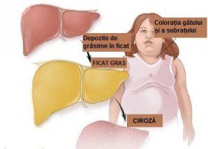 Ficatul gras – cauze și simptome