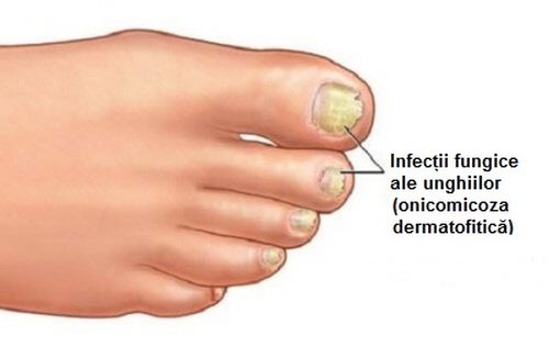 Micoza unghiilor (onicomicoza): cauze, simptome, transmitere, tratament, preventie | Bioclinica