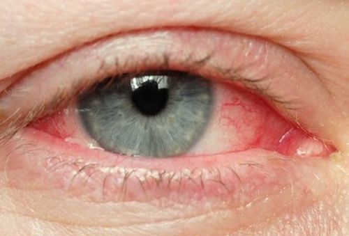 Ochii iritați - remedii naturale eficiente