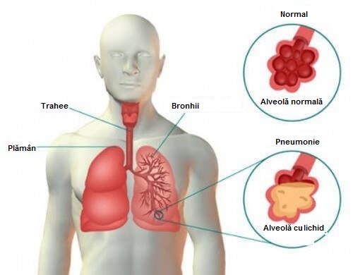 Pneumonia: simptome, cauze și tratament