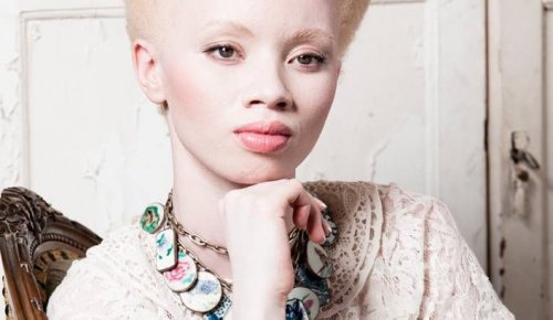 Albinismul: povestea fotomodelului Thando Hopa