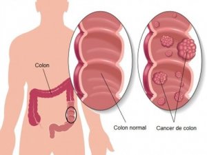 5 măsuri pentru prevenirea cancerului de colon