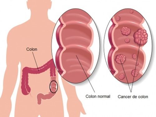 5 măsuri pentru prevenirea cancerului de colon