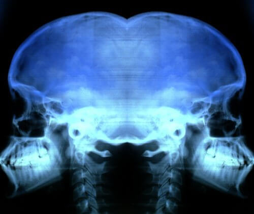 Radiografie pentru prevenirea și tratarea osteoporozei