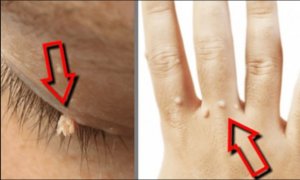 5 remedii naturale pentru negi