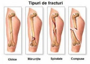 5 simptome ale cancerului osos primar