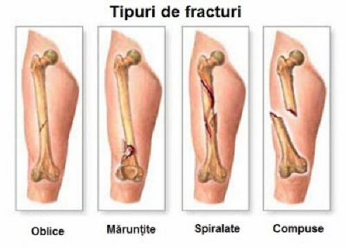sarcomul genunchiului