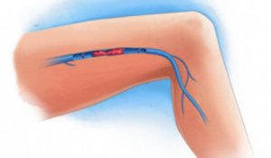 Tromboza venoasă: simptome și prevenire