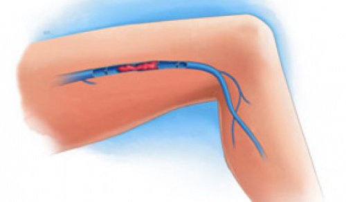 Tromboza venoasă: simptome și prevenire