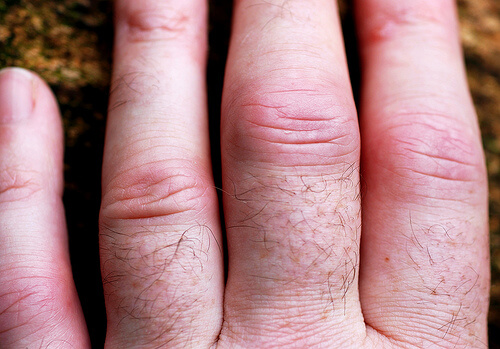 Artrita reumatoidă poate cauza deformări ale degetelor