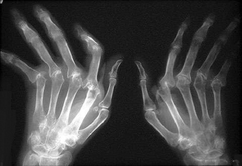 unde să tratezi artrita tratamentul eficient al articulațiilor mâinilor