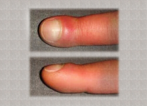Degetele umflate – cauze și remedii