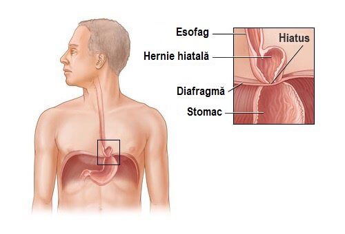 hernia-hiatală Hernia hiatală poate fi tratată